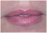 2-lip-after