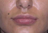 3-lip-after