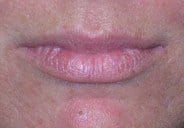4-lip-before