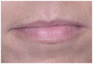 5-lip-before