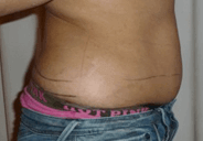 abdoment-after-2
