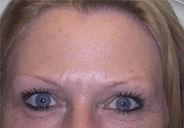 image botox forehead after