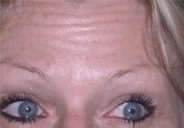 image botox forehead before