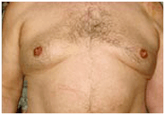 fat-accumulation-male-breast-area-after