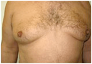 fat-accumulation-male-breast-area-before