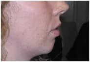 fillers-chin-before