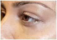 fillers-tear-trough-after