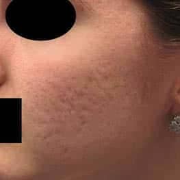 1-acne-scar-removal-before