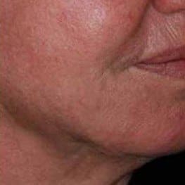 1-lower-face-lifting-after