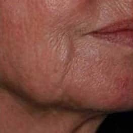 1-lower-face-lifting-before