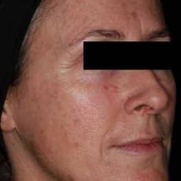 1-pigmentation-spot-removal-before