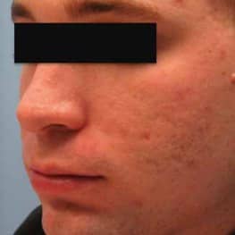 3-acne-scar-removal-after