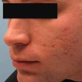 3-acne-scar-removal-before
