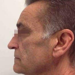 3-lower-face-lifting-after