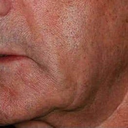 4-lower-face-lifting-before