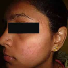 6-acne-scar-removal-after