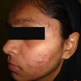 6-acne-scar-removal-before