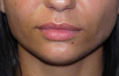 filler-lips-before-2
