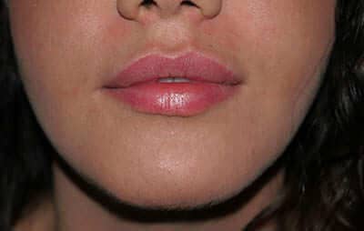 fillers-lips-after
