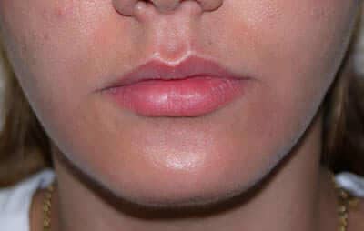 fillers-lips-before